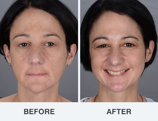 Facial before and after photos