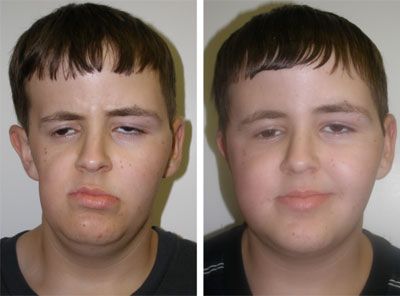 Facial fat implants