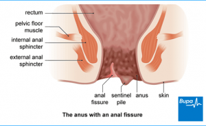 Nobel P. reccomend Anal fissure and platelets