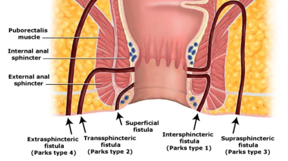 best of Anus Fistula in