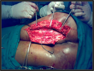 best of Anus Fistula in