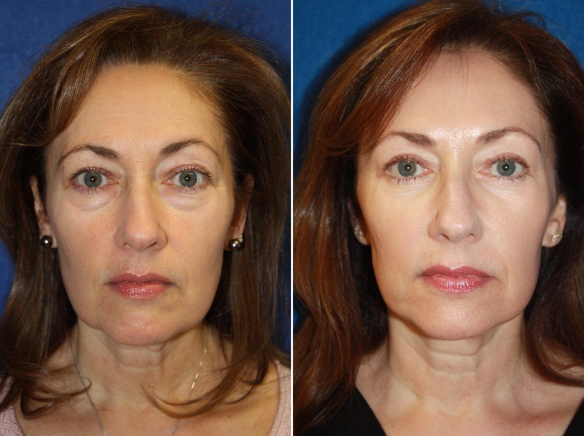 best of Laser Boston facial