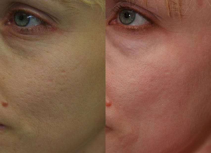 best of Laser Boston facial