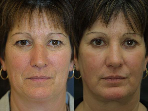 Boston facial laser