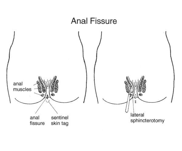 best of Skin tags Surgery for anal