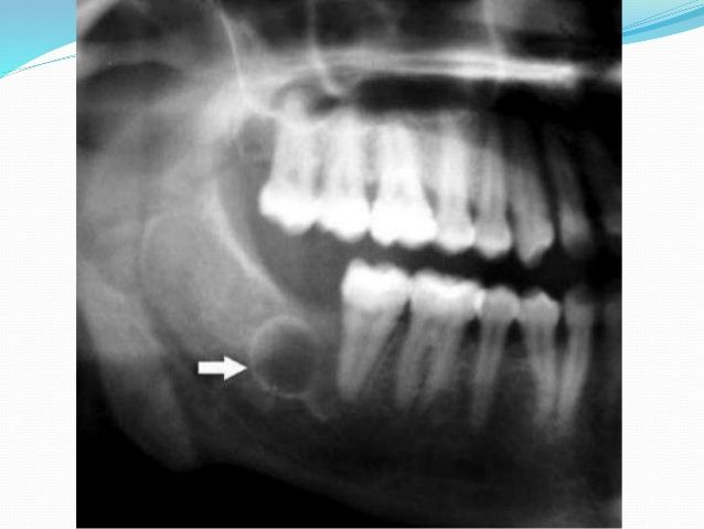 Sgt. C. reccomend Facial cusy by the jaw bone