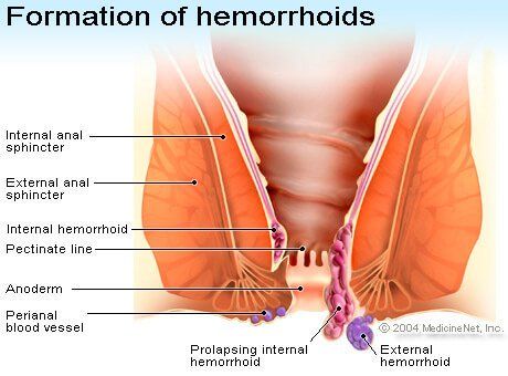 Iron reccomend Inflamed burning anus after bowel movement